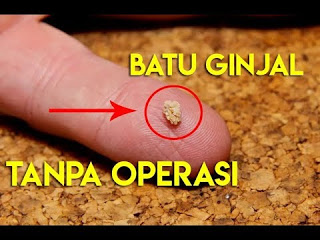 Illustration for article titled Akibat Penyakit Kencing Batu